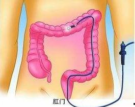 肠镜怎么做的过程视频